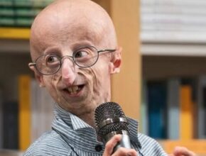 Sammy Basso: chi era e cos'è la progeria?